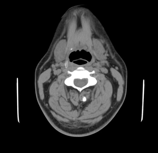 File:Colloid cyst of thyroid (Radiopaedia 22897-22923 Axial non-contrast 23).jpg