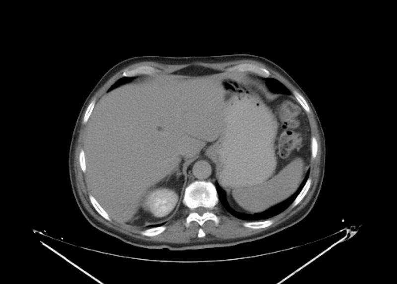 File:Colon cancer mimicking renal cell carcinoma (Radiopaedia 28986-29335 Axial C+ delayed 12).jpg
