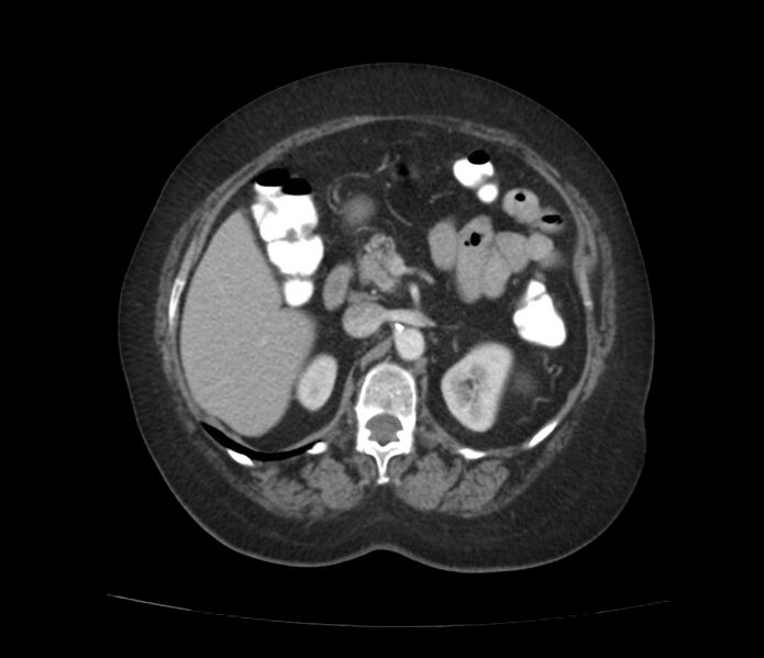 File:Colonic diverticulosis (Radiopaedia 22934-22957 A 24).jpg