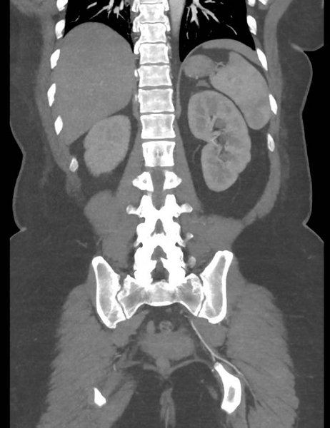 File:Colonic pseudo-obstruction (Radiopaedia 79752-92980 B 45).png