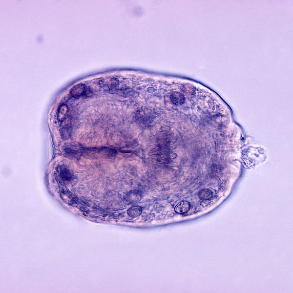 File:Echinococcus granulosus - scolex (photo) (Radiopaedia 36140).jpg