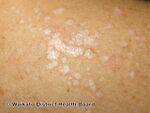 Lichen sclerosus on upper back (DermNet NZ guttate-lichen-sclerosus).jpg