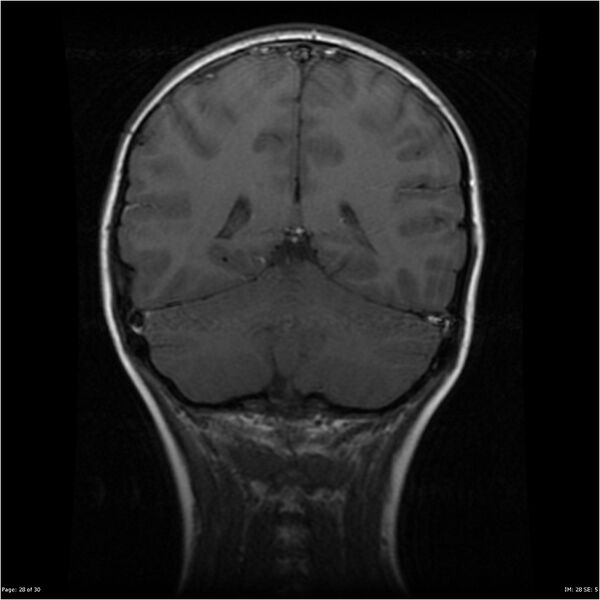File:Neurofibromatosis type 1 (Radiopaedia 22541-22564 Coronal T1 37).jpg