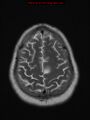 Neuroglial cyst (Radiopaedia 10713-11184 Axial T2 4).jpg