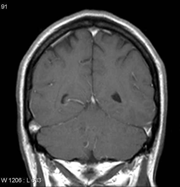 File:Neurosarcoidosis (Radiopaedia 10930-17204 Coronal T1 C+ 15).jpg