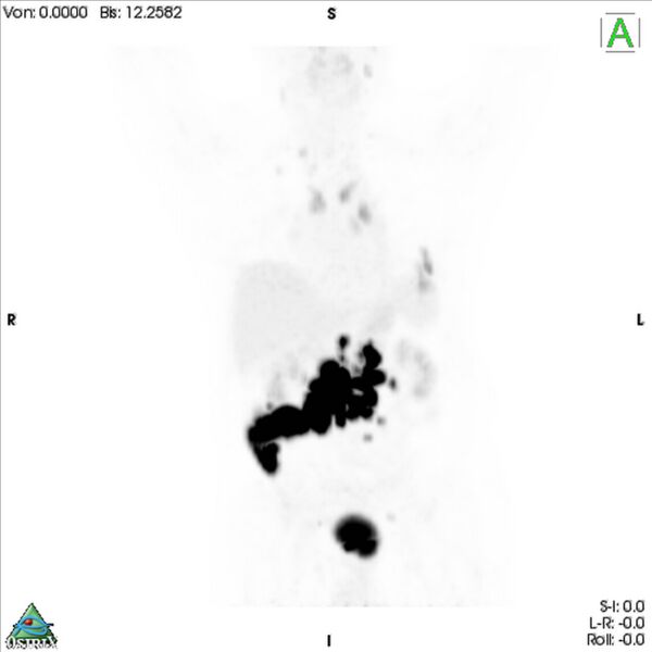 File:Non-Hodgkin lymphoma involving seminal vesicles with development of interstitial pneumonitis during Rituximab therapy (Radiopaedia 32703-33675 PET cor 3D MIP 1).jpg