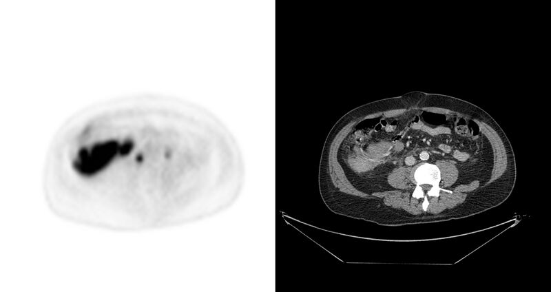 File:Non-Hodgkin lymphoma involving seminal vesicles with development of interstitial pneumonitis during Rituximab therapy (Radiopaedia 32703-33675 axial PET CT 23).jpg