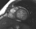 Non-compaction of the left ventricle (Radiopaedia 69436-79314 Short axis cine 120).jpg