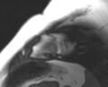 Non-compaction of the left ventricle (Radiopaedia 69436-79314 Short axis cine 17).jpg
