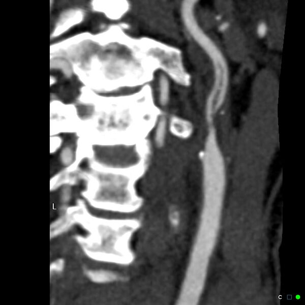 File:Non-occlusive intraluminal internal carotid artery thrombus (Radiopaedia 37751-39658 A 35).jpg