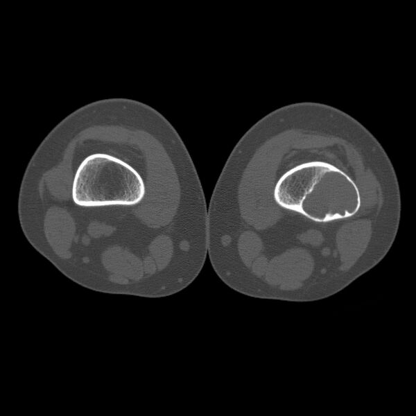 File:Non-ossifying fibroma - distal femur (Radiopaedia 8111-8948 Axial bone window 1).jpg
