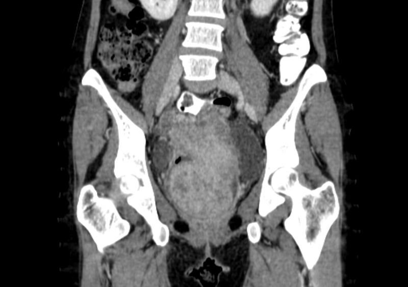 File:Non-puerperal uterine inversion (Radiopaedia 78343-91094 B 10).jpg
