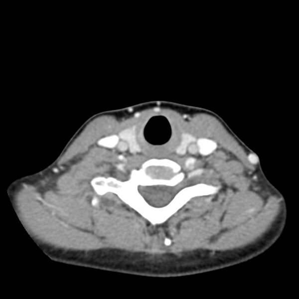File:Normal CT of the neck (Radiopaedia 14575-14500 Axial C+ 50).jpg