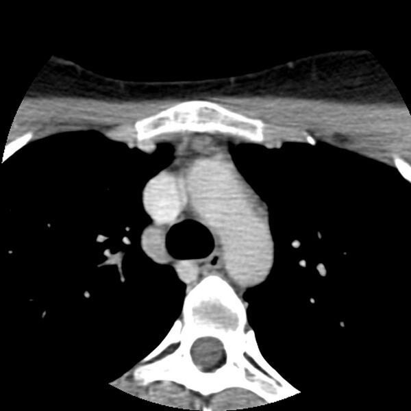 File:Normal CT of the neck (Radiopaedia 14575-14500 Axial C+ 78).jpg