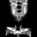 Normal CT of the neck (Radiopaedia 14575-14500 Coronal C+ 21).jpg