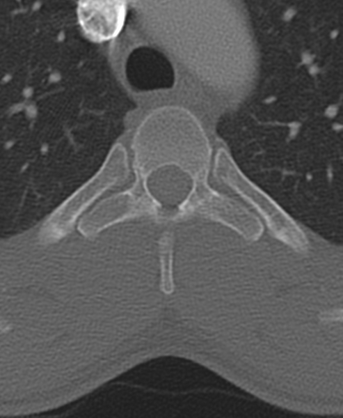 File:Normal CT thoracic spine (Radiopaedia 40181-42688 Axial bone window 29).png