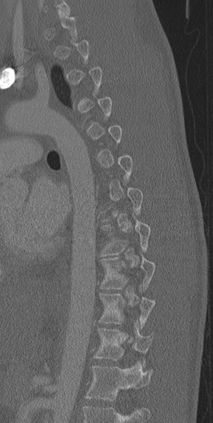 File:Normal CT thoracic spine (Radiopaedia 40181-42688 Sagittal bone window 23).png