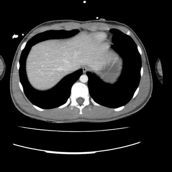 File:Normal dual-phase trauma CT chest,abdomen and pelvis (Radiopaedia 48092-52899 A 46).jpg
