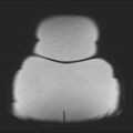 Normal liver MRI with Gadolinium (Radiopaedia 58913-66163 Coronal T2 45).jpg