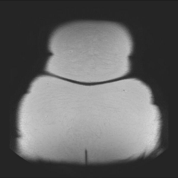 File:Normal liver MRI with Gadolinium (Radiopaedia 58913-66163 Coronal T2 45).jpg