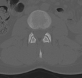 Normal lumbar spine CT (Radiopaedia 46533-50986 Axial bone window 31).png