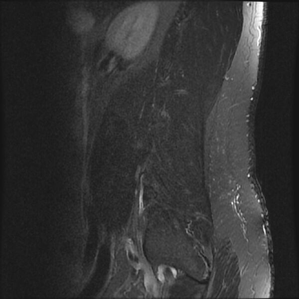 File:Normal lumbar spine MRI (Radiopaedia 43051-46311 Sagittal STIR 20).jpg