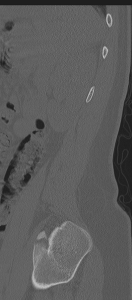 File:Normal lumbosacral CT (Radiopaedia 37923-39867 Sagittal bone window 12).png