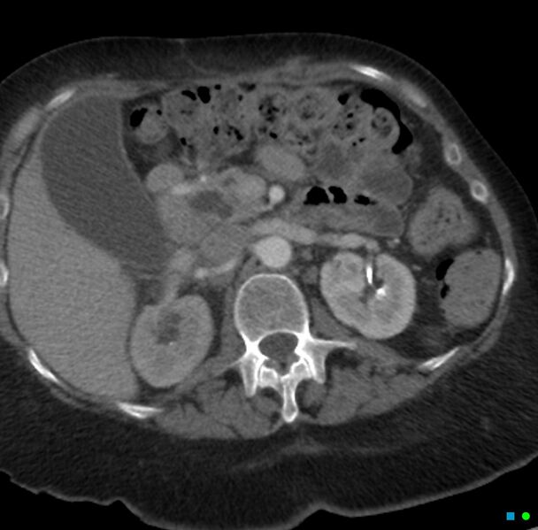 File:Obstructed infected horseshoe kidney (Radiopaedia 18116-17898 B 5).jpg