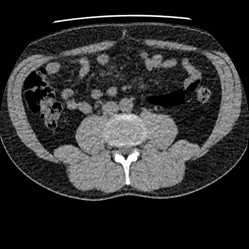 Obstructing ureteric calculus and ureteric anatomy (Radiopaedia 62730-71042 Axial non-contrast 74).jpg