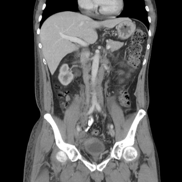 File:Obstructive bladder transitional cell carcinoma (Radiopaedia 9825-10410 B 10).jpg