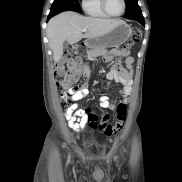 File:Obstructive bladder transitional cell carcinoma (Radiopaedia 9825-10410 B 2).jpg