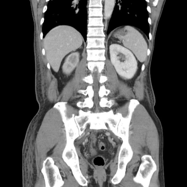 File:Obstructive bladder transitional cell carcinoma (Radiopaedia 9825-10410 B 20).jpg