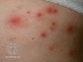 Spa pool folliculitis (DermNet NZ acne-spapool-folliculitis).jpg