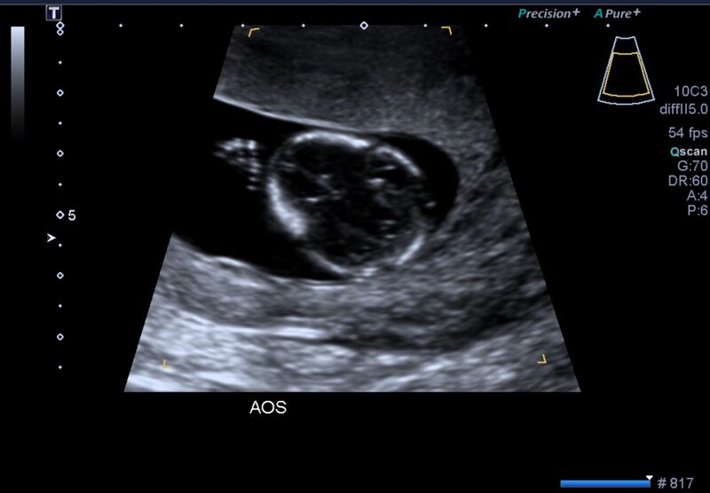 File:1st trimester nuchal-morphology ultrasound (Radiopaedia 44706-48477 General anatomy and NT 13).jpg