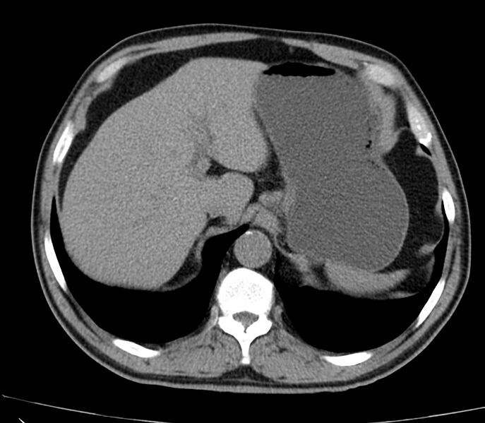 File:Abdominal aortic aneurysm (Radiopaedia 22421-22458 non-contrast 9).jpg