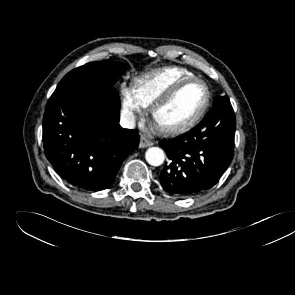 File:Abdominal aortic aneurysm (Radiopaedia 75131-86203 Axial C+ arterial phase 4).jpg