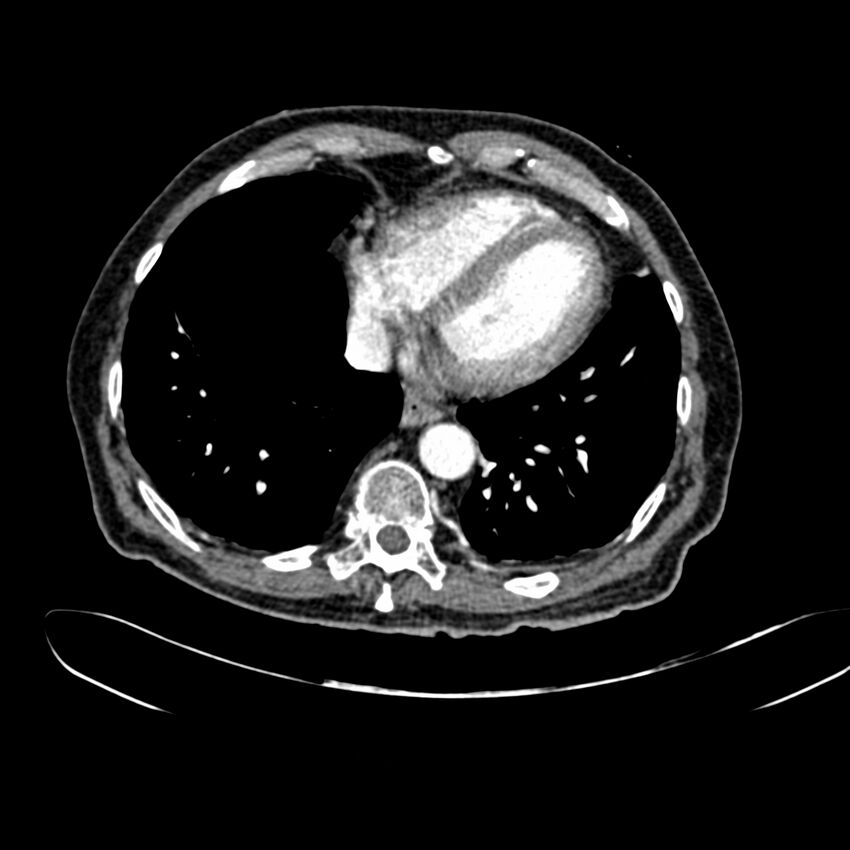 Abdominal aortic aneurysm (Radiopaedia 75131-86203 Axial C+ arterial phase 4).jpg