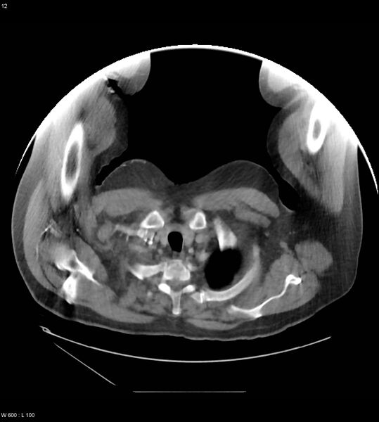 File:Abdominal aortic aneurysm with intramural hematoma then rupture (Radiopaedia 50278-55631 Axial C+ arterial phase 3).jpg
