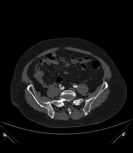 File:Abdominal aortic aneurysm with thrombus fissuration (Radiopaedia 46218-50618 Axial C+ arterial phase 30).jpg