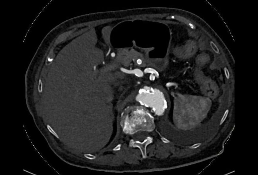 Abdominal aortic aneurysm with thrombus fissuration (Radiopaedia 73192-83919 Axial C+ arterial phase 28).jpg
