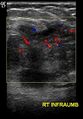 Abdominal wall endometriosis (Radiopaedia 25723-25886 A 1).jpg