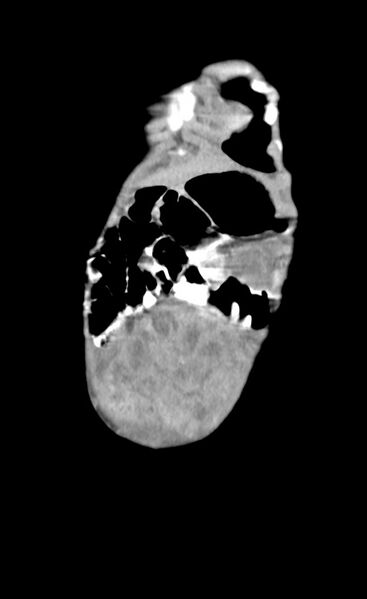 File:Abdominopelvic rhabdomyosarcoma (Radiopaedia 78356-90984 Coronal C+ portal venous phase 11).jpg