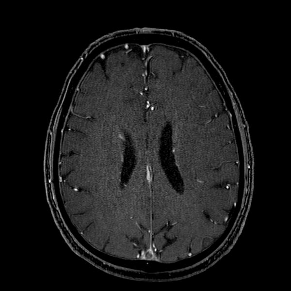 File:Accessory middle cerebral artery (Radiopaedia 73114-83828 Axial MRA 140).jpg