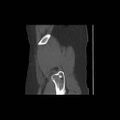 Acetabular fracture (Radiopaedia 13193-13212 Sagittal bone window 7).jpg