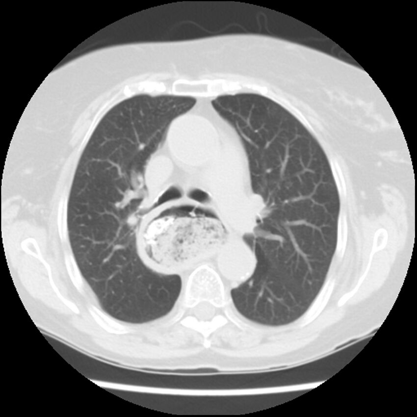 Achalasia (Radiopaedia 44094-47649 Axial lung window 23).jpg