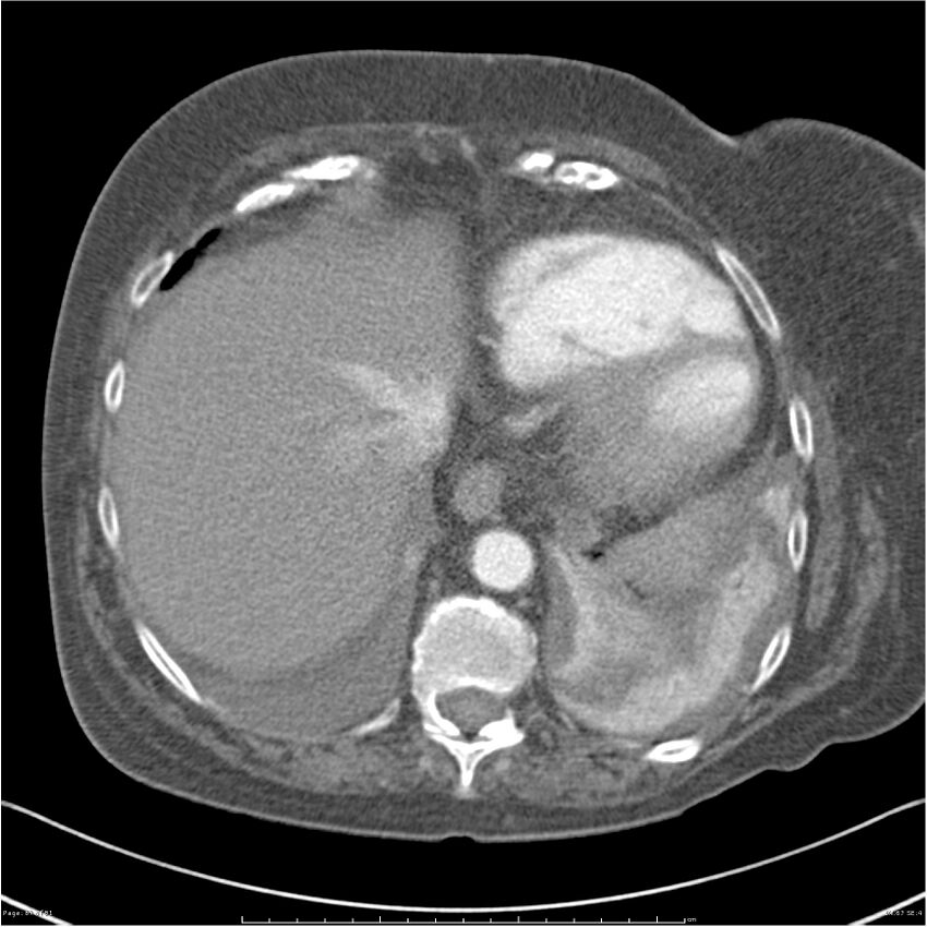 Acute-on-chronic pulmonary emboli (Radiopaedia 27925-28169 C+ CTPA 67).jpg