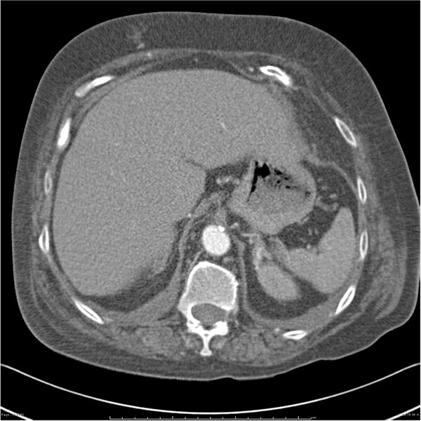 File:Acute-on-chronic pulmonary emboli (Radiopaedia 27925-28169 C+ CTPA 78).jpg