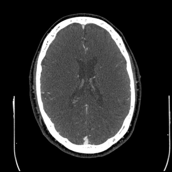 File:Acute A3 occlusion with ACA ischemic penumbra (CT perfusion) (Radiopaedia 72036-82527 Axial C+ arterial phase thins 42).jpg