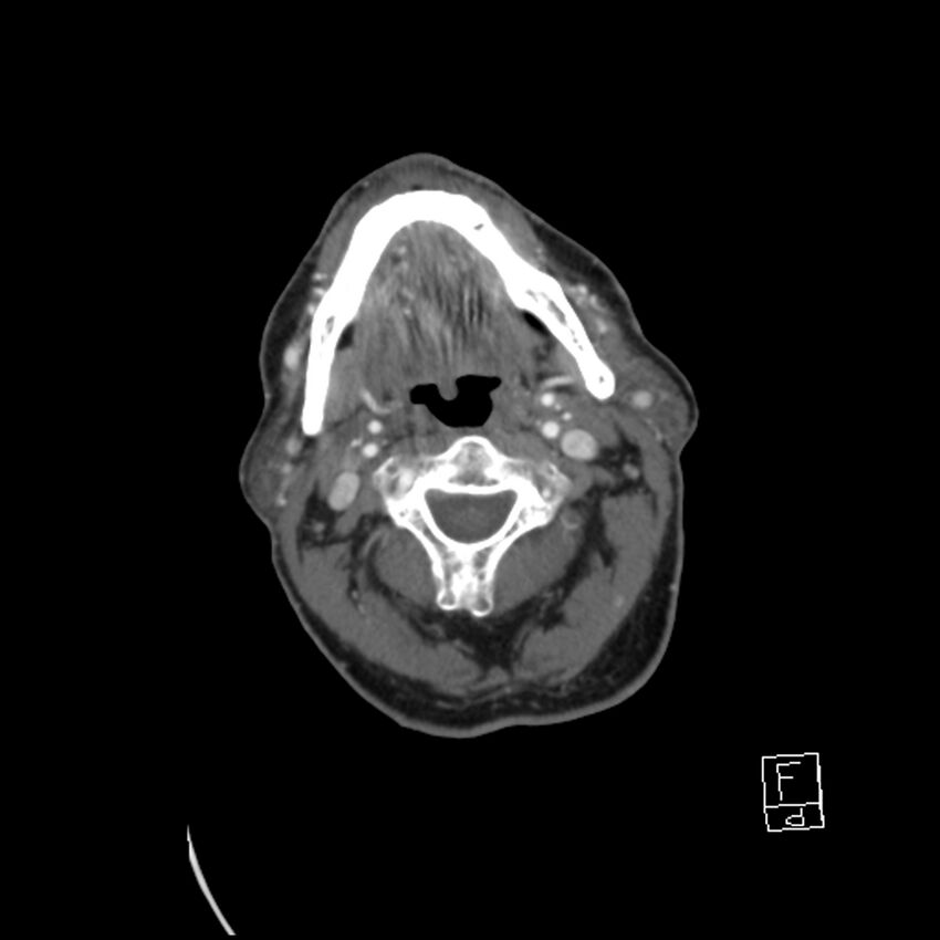 Acute ICA ischemic penumbra due to high-grade CCA stenosis (CT perfusion) (Radiopaedia 72038-82530 Axial C+ arterial phase 35).jpg