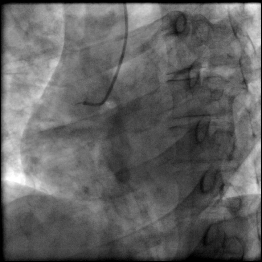 Acute anteroseptal myocardial infarction (Radiopaedia 68409-77946 RAO straight RCA 6).jpg